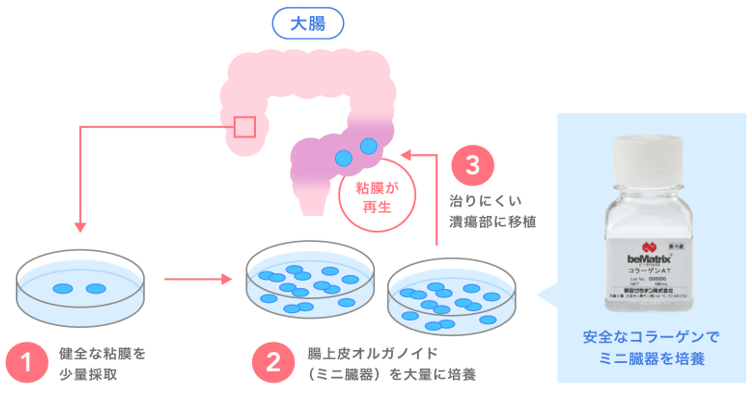 潰瘍性大腸炎患者への移植治療に用いられたミニ臓器の培養