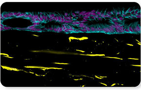 Esophageal adenocarcinoma progression on chip