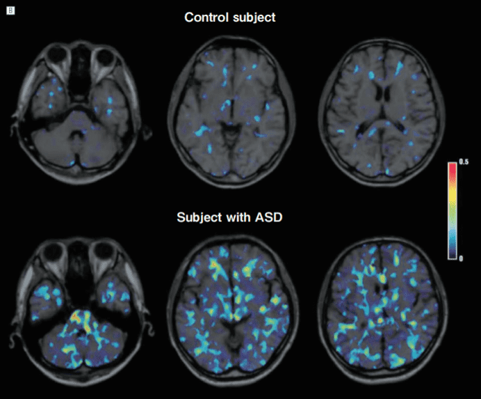 図１．自閉症スペクトラム障害（ASD）患者脳における活性化ミクログリアの増加