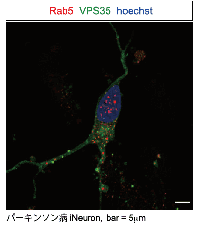 パーキンソン病iNeuron