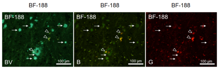 Staining image of senile plaques and neurofibrillary tangles with fluorescent probe BF-188