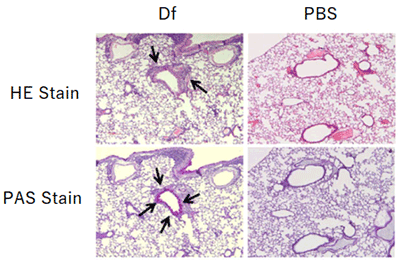 Pathological findings of the pulmonary bronchi