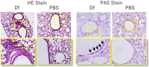 Pathological findings of the pulmonary bronchi