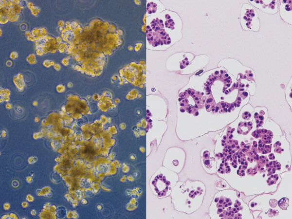 Lung F-PDO (papillary adenocarcinoma)<