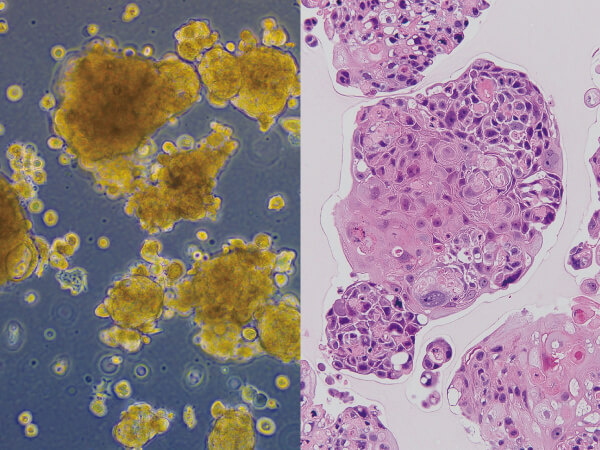 Lung F-PDO (squamous cell carcinoma)